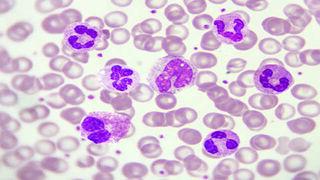 Eosinophil in Eosinophilic Granulomatosis with Polyangiitis illustration